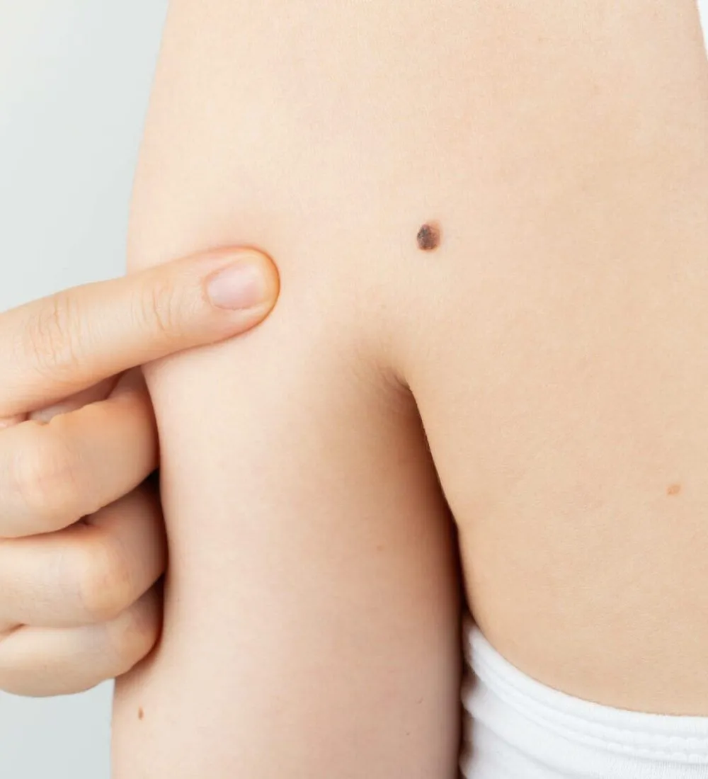Mole assessment and removal at Waterfront Private Hospital, Edinburgh